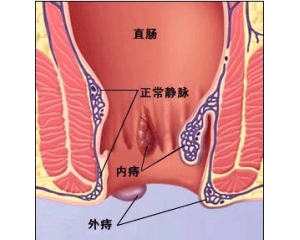 专家详解:脱肛痔疮图片